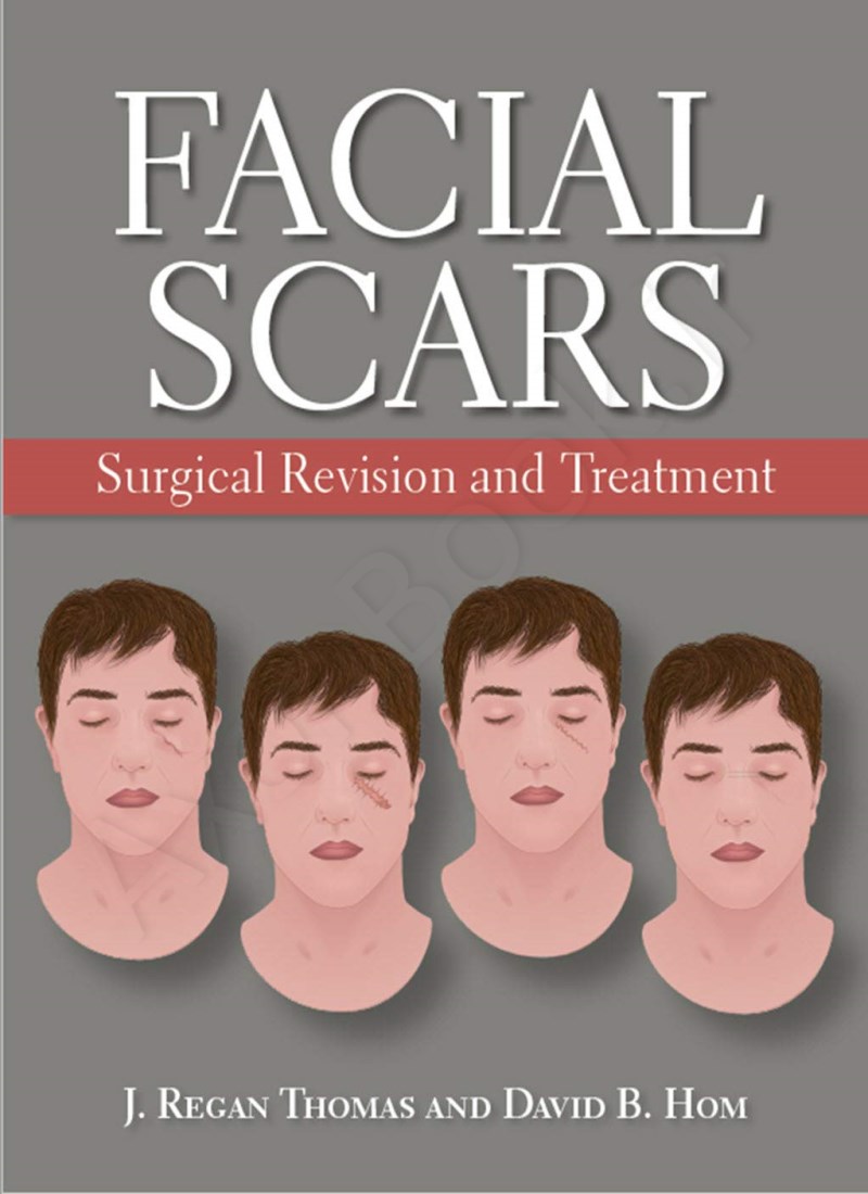 Facial Scars: Surgical Revision and Treatment Model.Title
