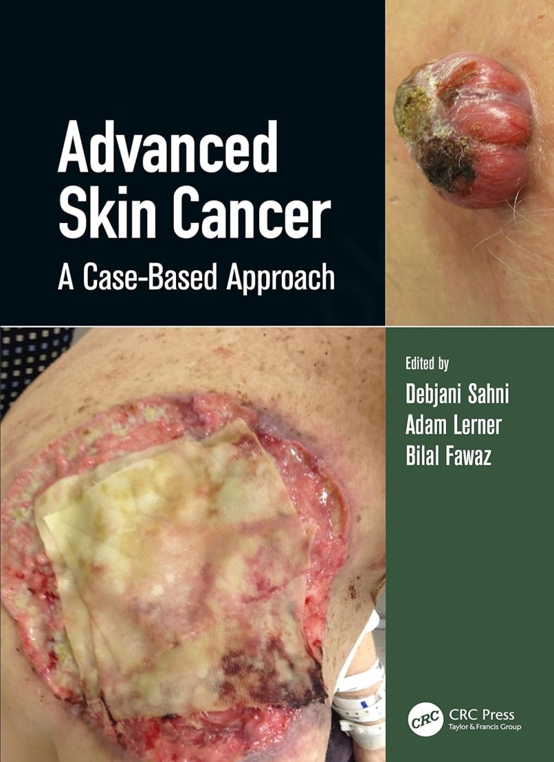 Advanced Skin Cancer: A Case-Based Approach main 1 1