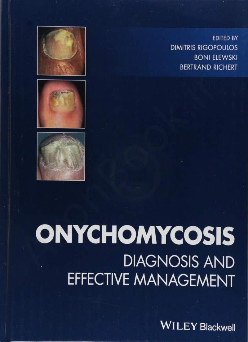 Onychomycosis: Diagnosis and Effective Management main 1 1