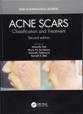 Acne Scars: Classification and Treatment thumb 2 1