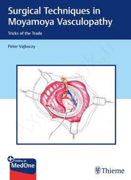Surgical Techniques in Moyamoya Vasculopathy: Tricks of the Trade thumb 2 1