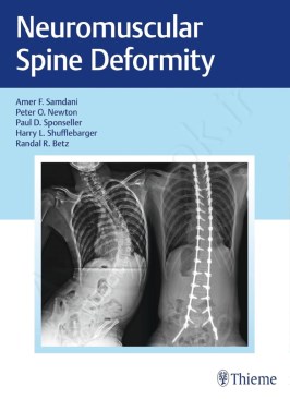 Neuromuscular Spine Deformity thumb 2 1